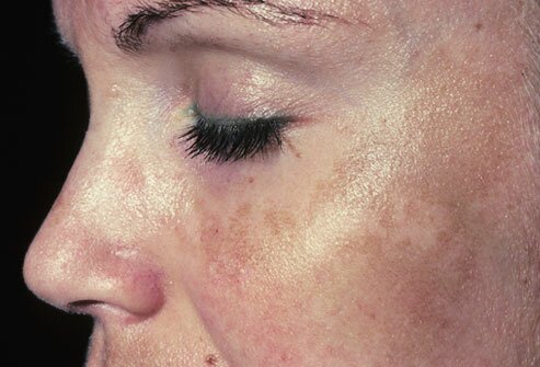 Melasma Common Causes