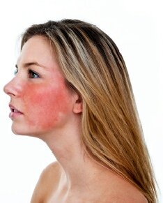 Home Remedies for Rosacea